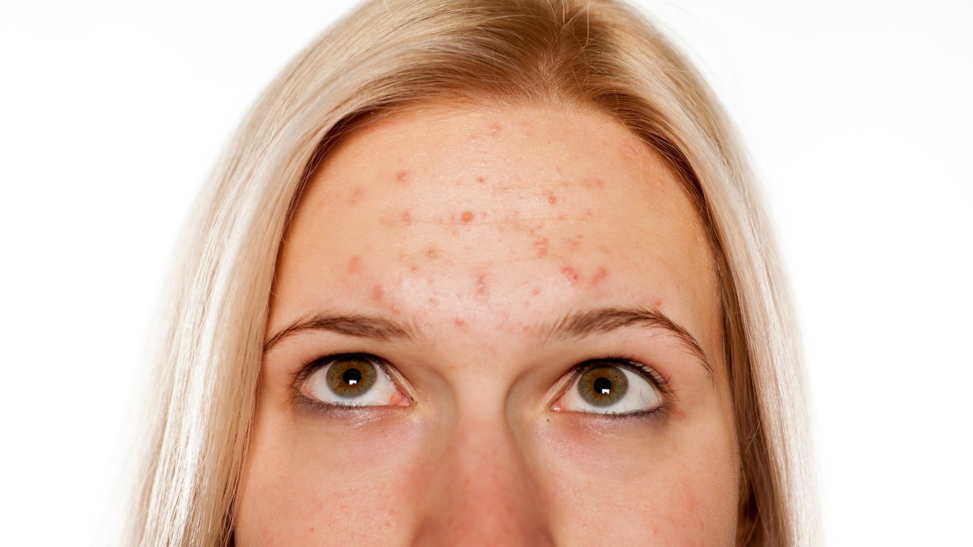 Você está visualizando atualmente Tratamento de acne com Roacutan