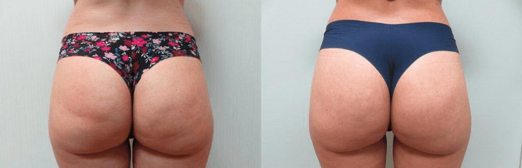 No momento, você está visualizando Subcisão para celulite