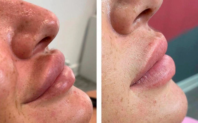 Leia mais sobre o artigo Preenchimento mal sucedido : Como resolver?