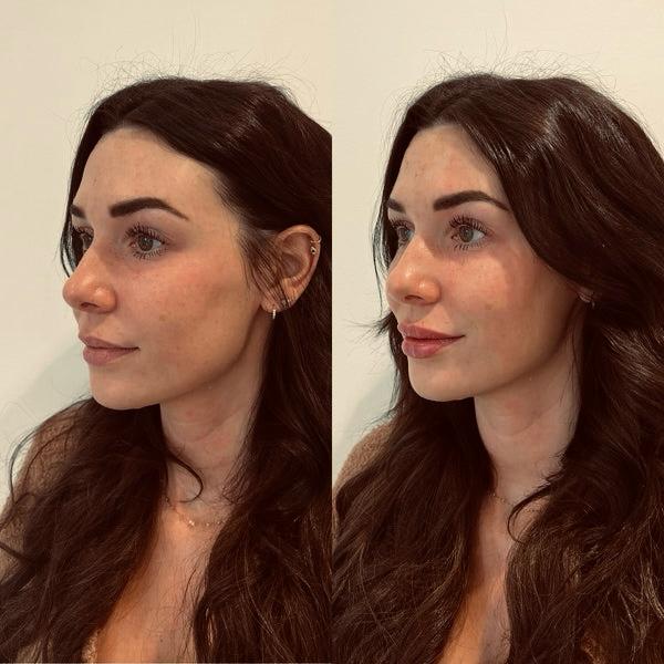 Leia mais sobre o artigo Preenchimento Labial: Quando é indicado e como e feito