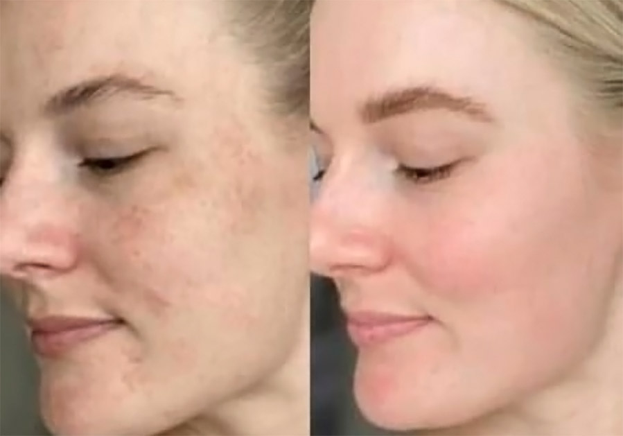 No momento, você está visualizando O que é Melasma e como tratá-lo?