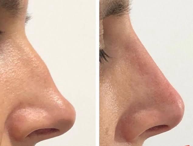 Leia mais sobre o artigo Rinomodelação: O que você precisa saber