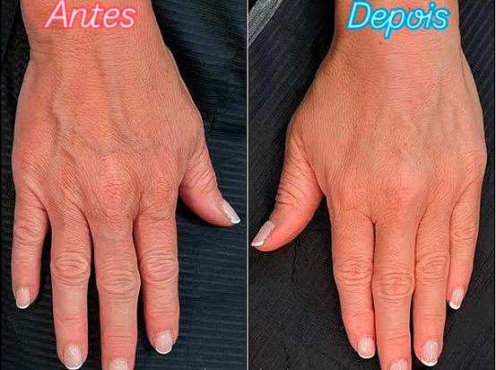 Leia mais sobre o artigo Rejuvenescimento das mãos