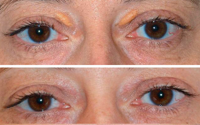 Leia mais sobre o artigo Xantelasma: Tratamento